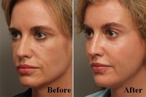 미국에서 많이하는 성형수술 세가지 | 인스티즈