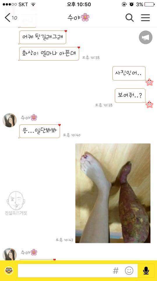 남자친구한테 화상입었다고 구라를 쳐봤다 | 인스티즈
